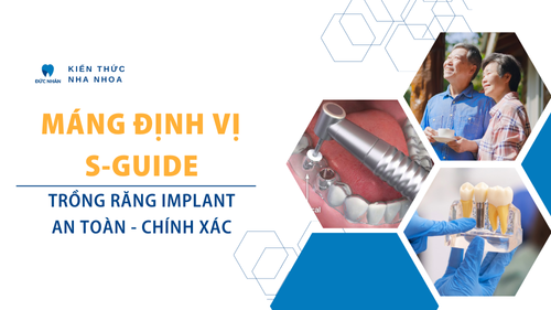 Trồng răng Implant chính xác, an toàn cùng máng định S-guide thông minh